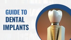 guide to dental implants