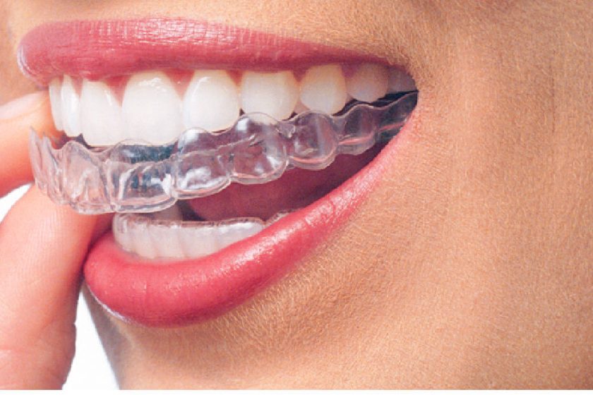 Invisalign in the UK